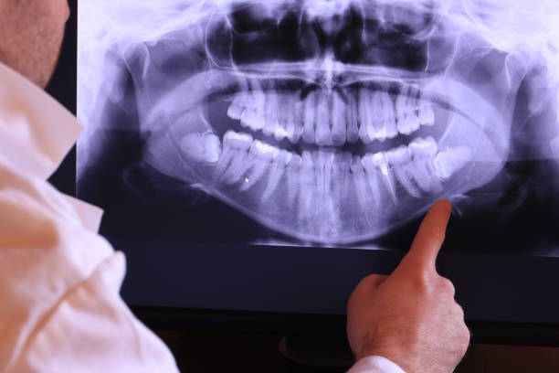 Emergency Dental Filling Replacement in NY